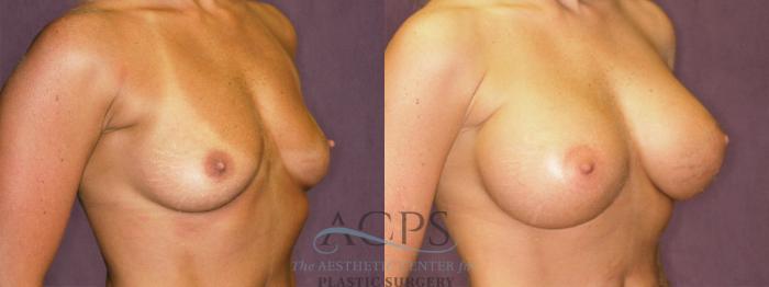 Before & After Breast Augmentation Case 946 Oblique Right View: View in Houston, TX
