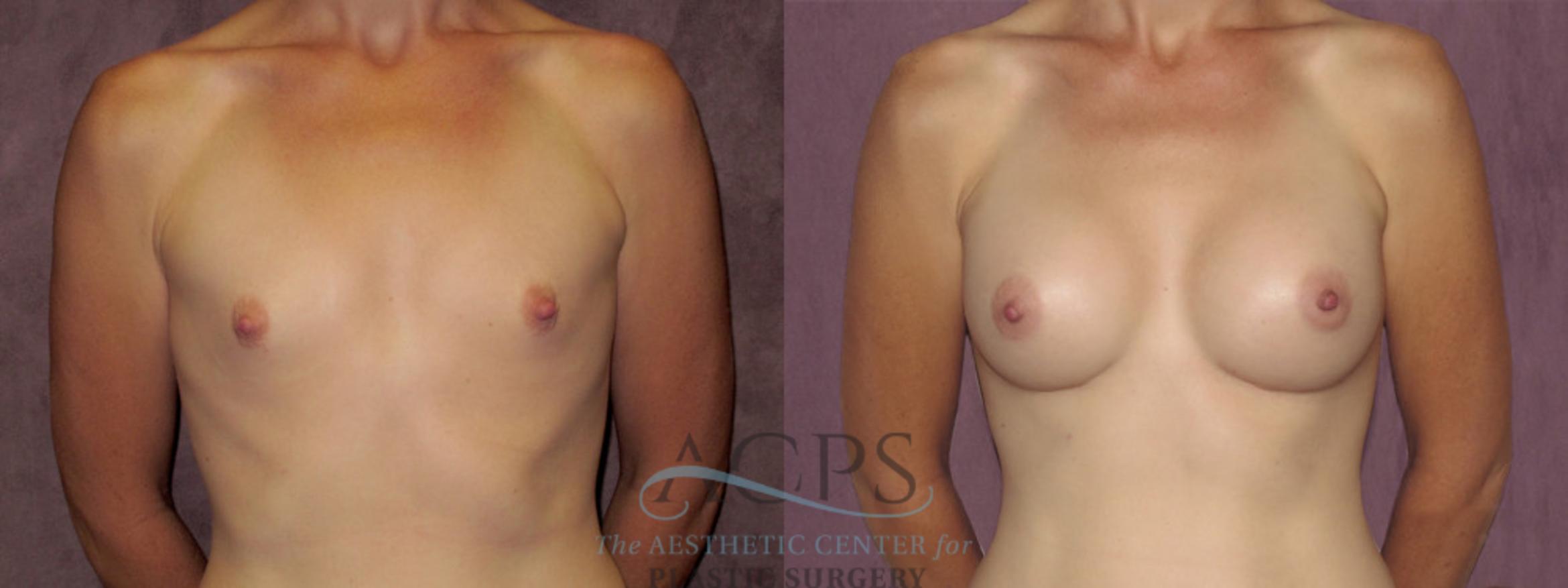 Before & After Breast Augmentation Case 947 Front View: View in Houston, TX