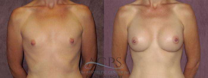 Before & After Breast Augmentation Case 947 Front View: View in Houston, TX