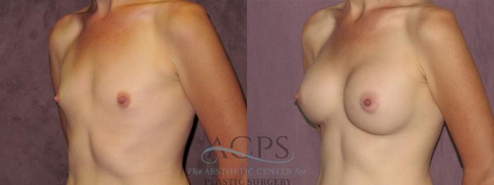 Before & After Breast Augmentation Case 947 Oblique Left View: View in Houston, TX