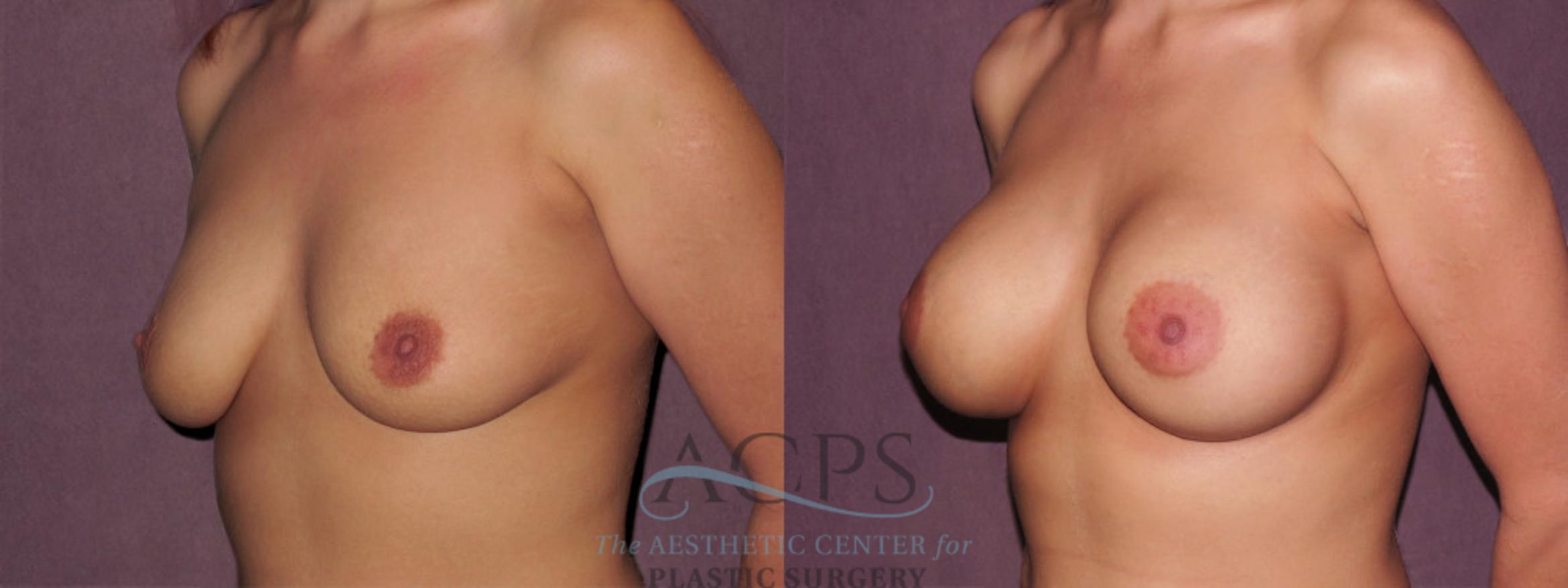 Before & After Breast Augmentation Case 948 Oblique Left View: View in Houston, TX