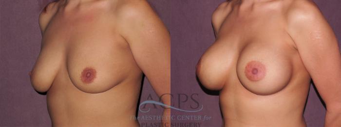 Before & After Breast Augmentation Case 948 Oblique Left View: View in Houston, TX