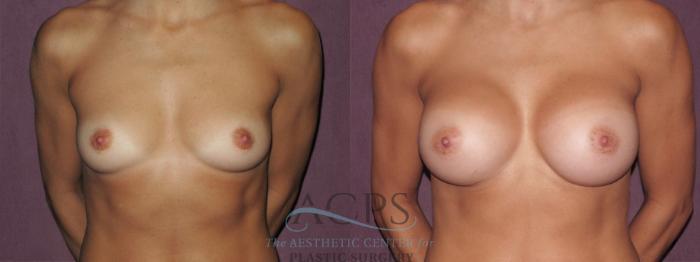 Before & After Breast Augmentation Case 949 Front View: View in Houston, TX