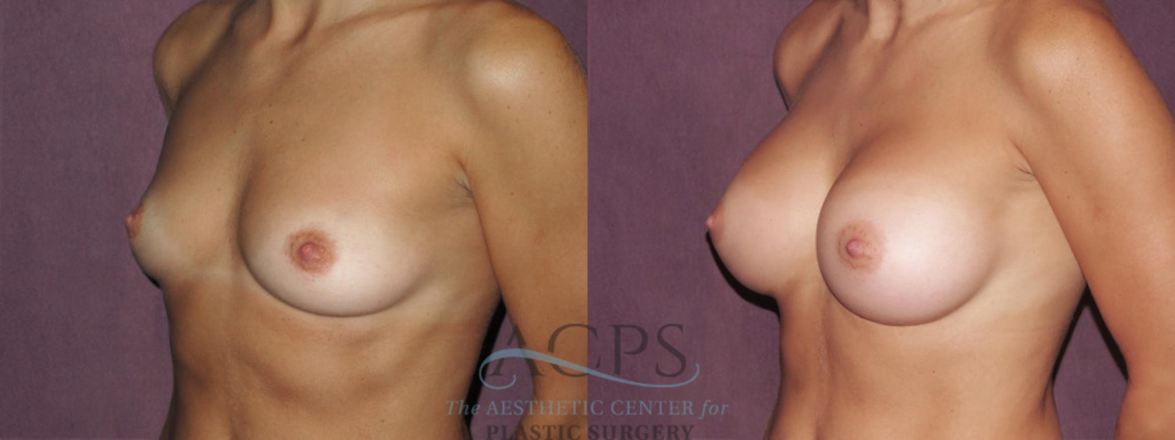 Before & After Breast Augmentation Case 949 Oblique Left View: View in Houston, TX