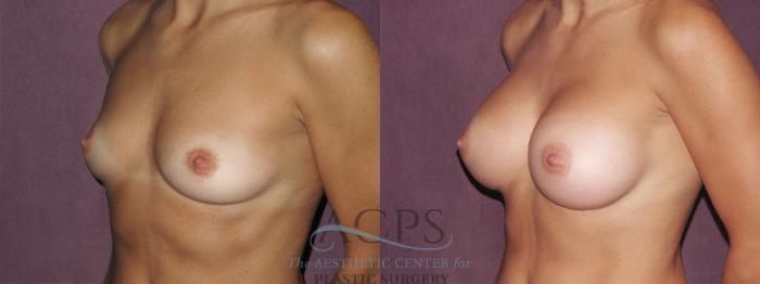 Before & After Breast Augmentation Case 949 Oblique Left View: View in Houston, TX