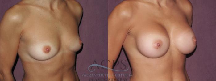 Before & After Breast Augmentation Case 949 Oblique Right View: View in Houston, TX