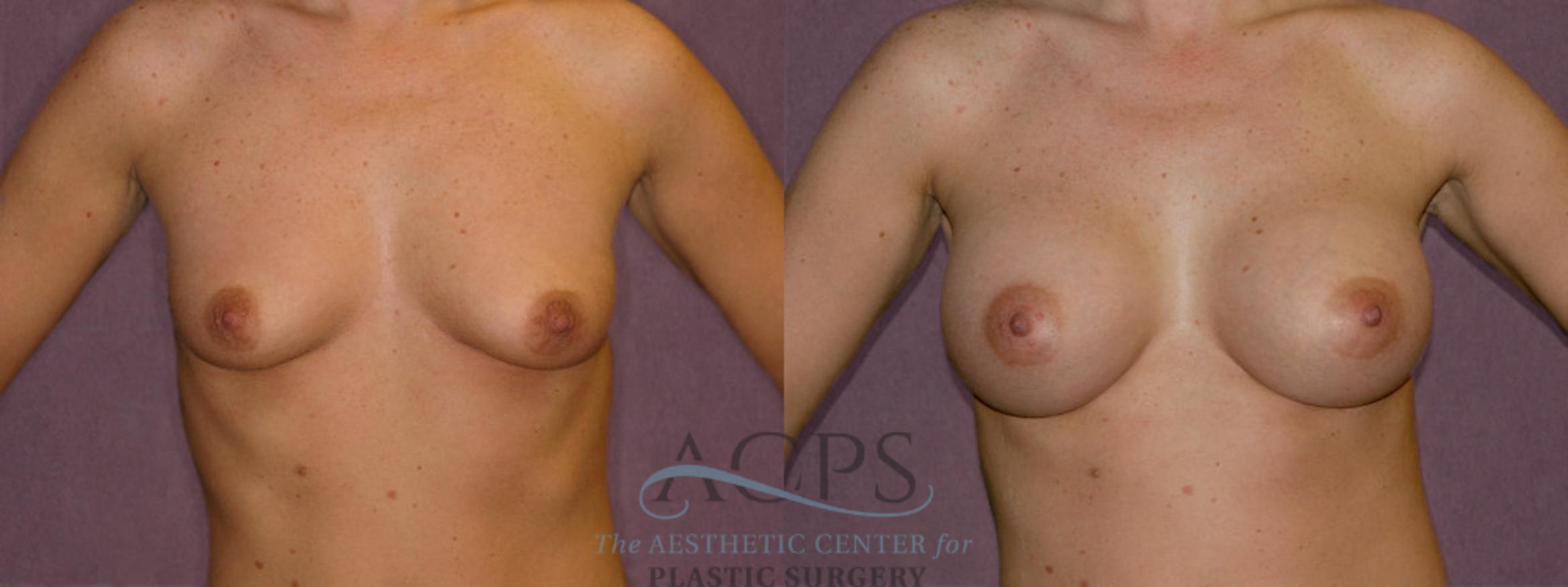 Before & After Breast Augmentation Case 950 Front View: View in Houston, TX