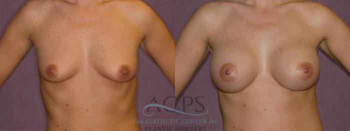 Before & After Breast Augmentation Case 950 Front View: View in Houston, TX