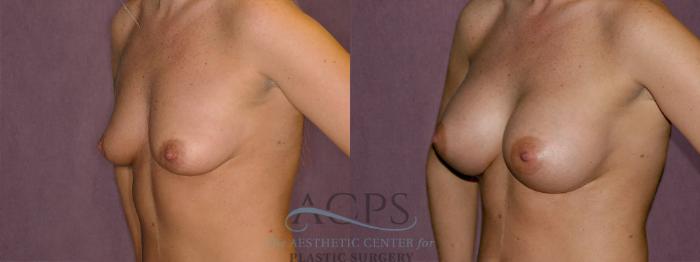 Before & After Breast Augmentation Case 950 Oblique Left View: View in Houston, TX