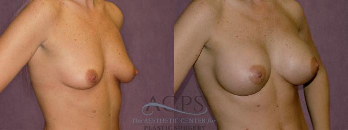 Before & After Breast Augmentation Case 950 Oblique Right View: View in Houston, TX