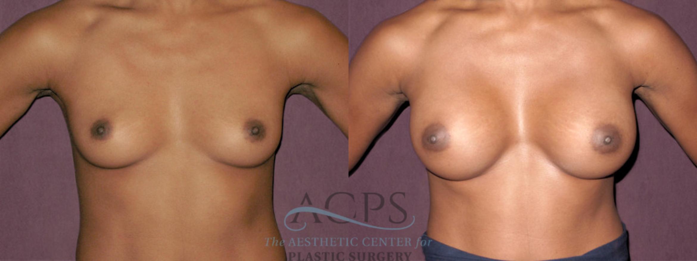 Before & After Breast Augmentation Case 951 Front View: View in Houston, TX