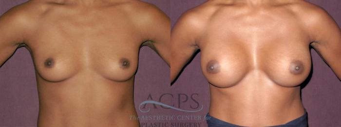 Before & After Breast Augmentation Case 951 Front View: View in Houston, TX
