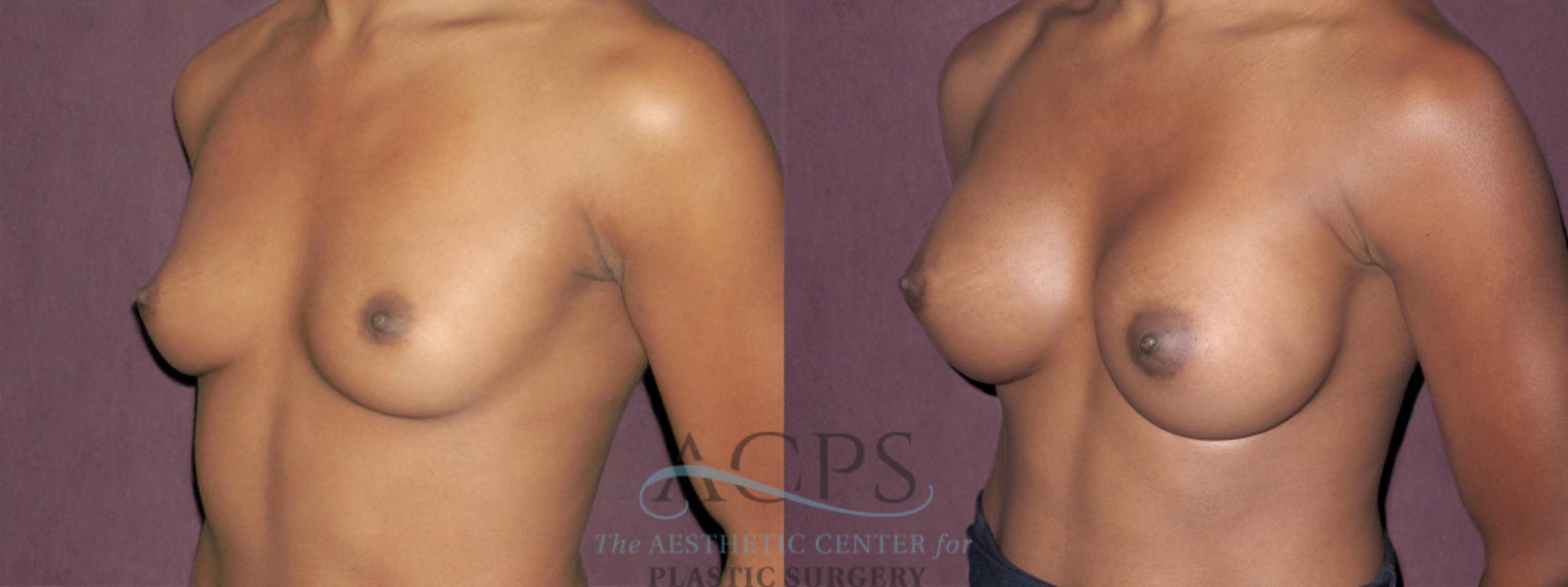 Before & After Breast Augmentation Case 951 Oblique Left View: View in Houston, TX