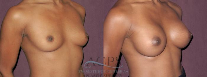 Before & After Breast Augmentation Case 951 Oblique Right View: View in Houston, TX