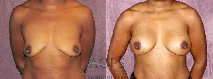 Before & After Breast Augmentation Case 952 Front View: View in Houston, TX