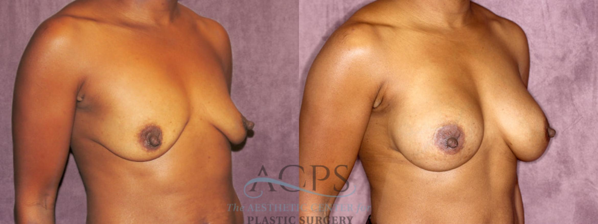 Before & After Breast Augmentation Case 952 Oblique Right View: View in Houston, TX