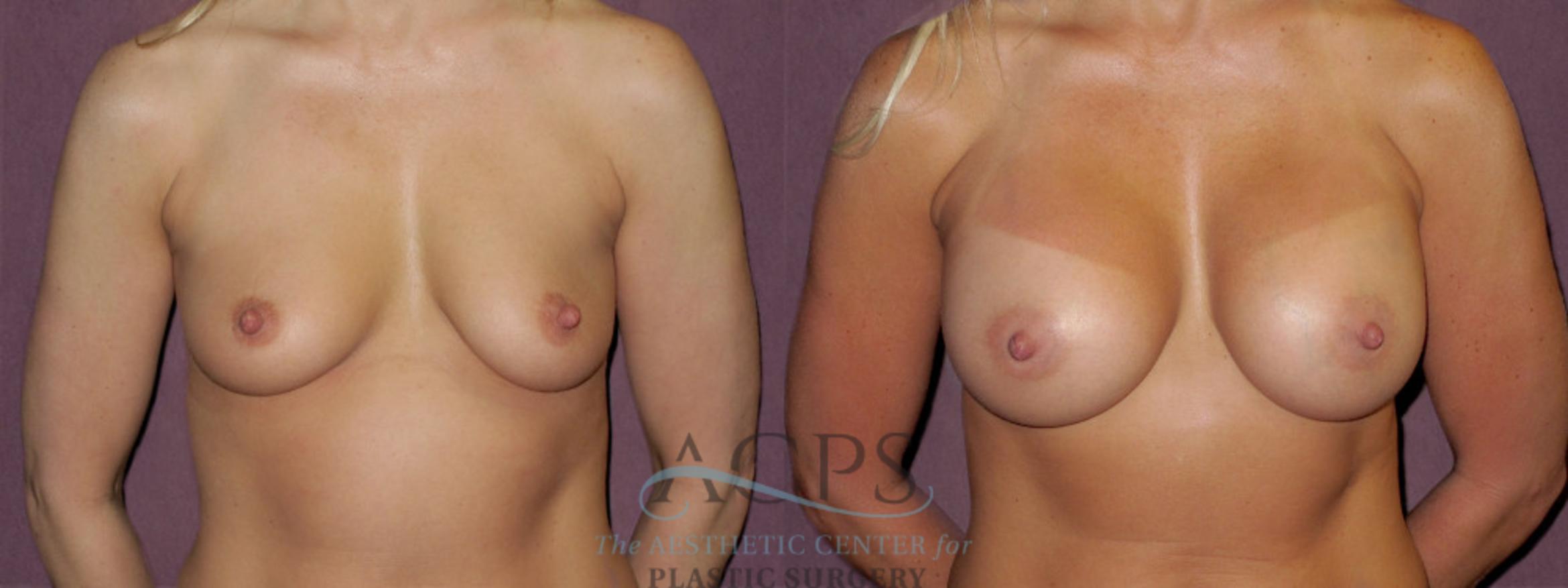 Before & After Breast Augmentation Case 953 Front View: View in Houston, TX
