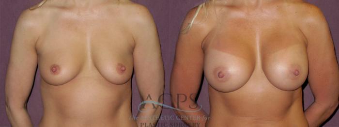 Before & After Breast Augmentation Case 953 Front View: View in Houston, TX