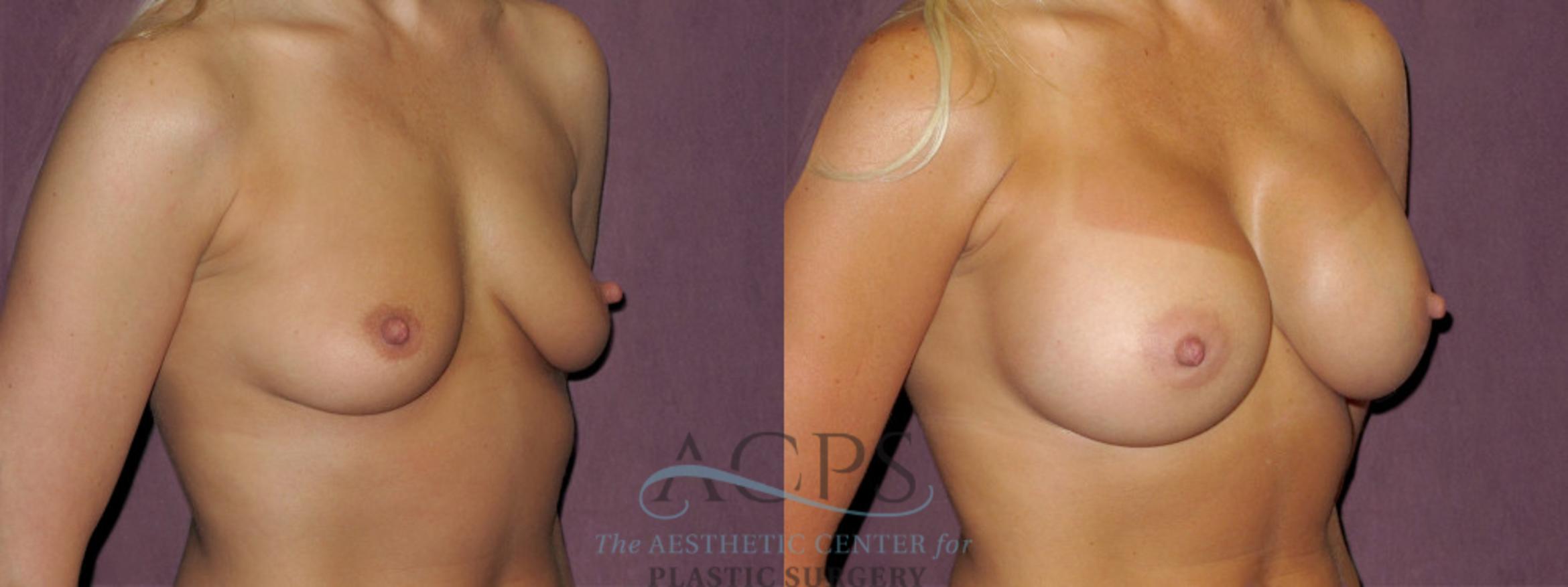 Before & After Breast Augmentation Case 953 Oblique Right View: View in Houston, TX