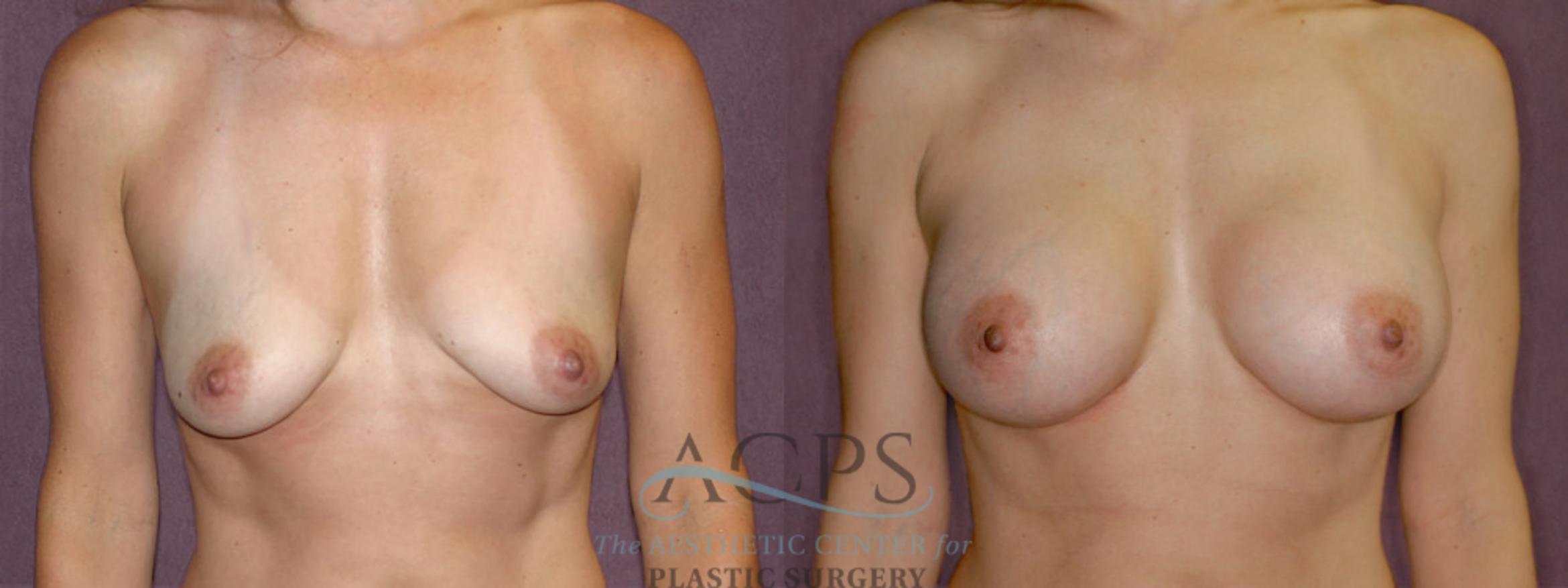 Before & After Breast Augmentation Case 954 Front View: View in Houston, TX