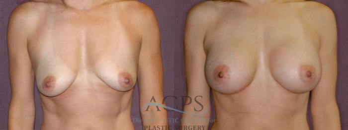 Before & After Breast Augmentation Case 954 Front View: View in Houston, TX