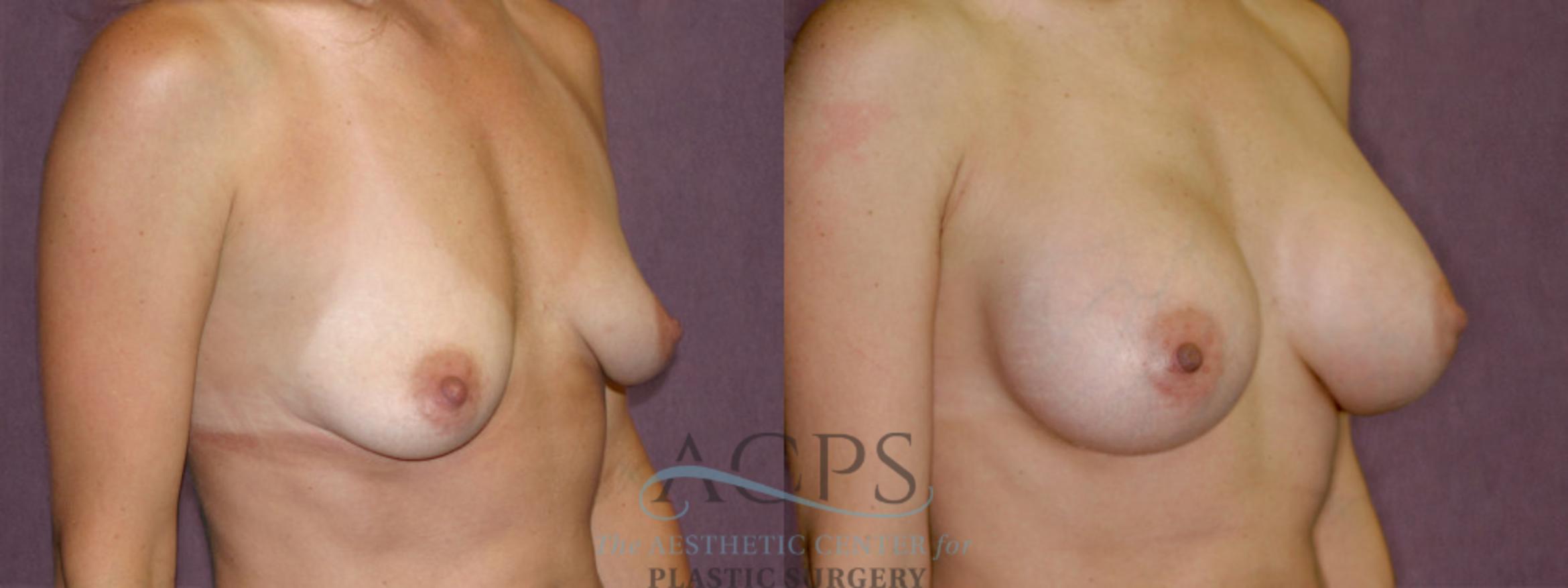 Before & After Breast Augmentation Case 954 Oblique Right View: View in Houston, TX