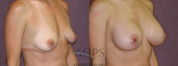 Before & After Breast Augmentation Case 954 Oblique Right View: View in Houston, TX