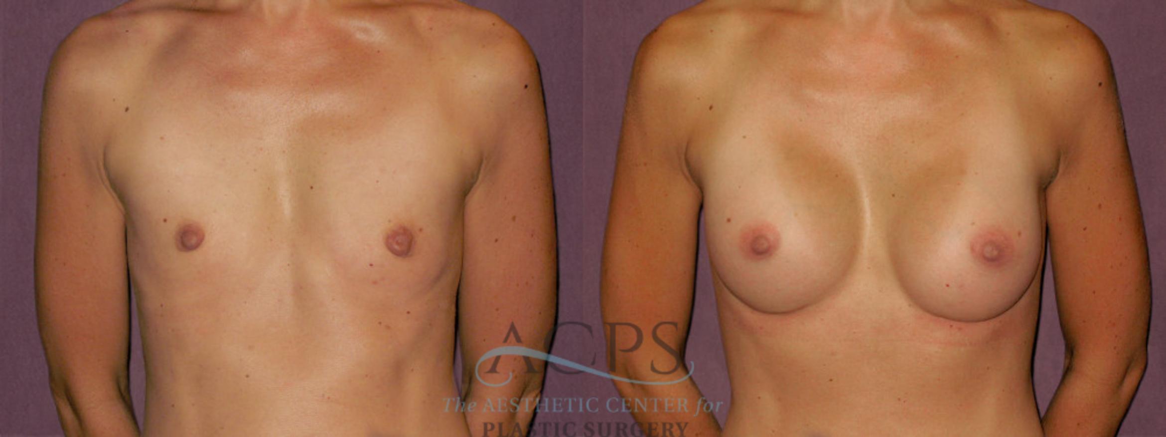 Before & After Breast Augmentation Case 955 Front View: View in Houston, TX