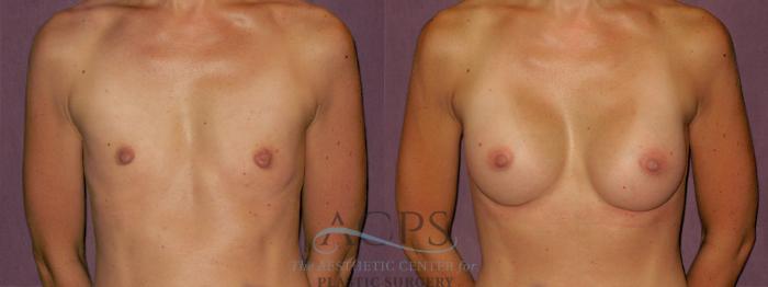 Before & After Breast Augmentation Case 955 Front View: View in Houston, TX