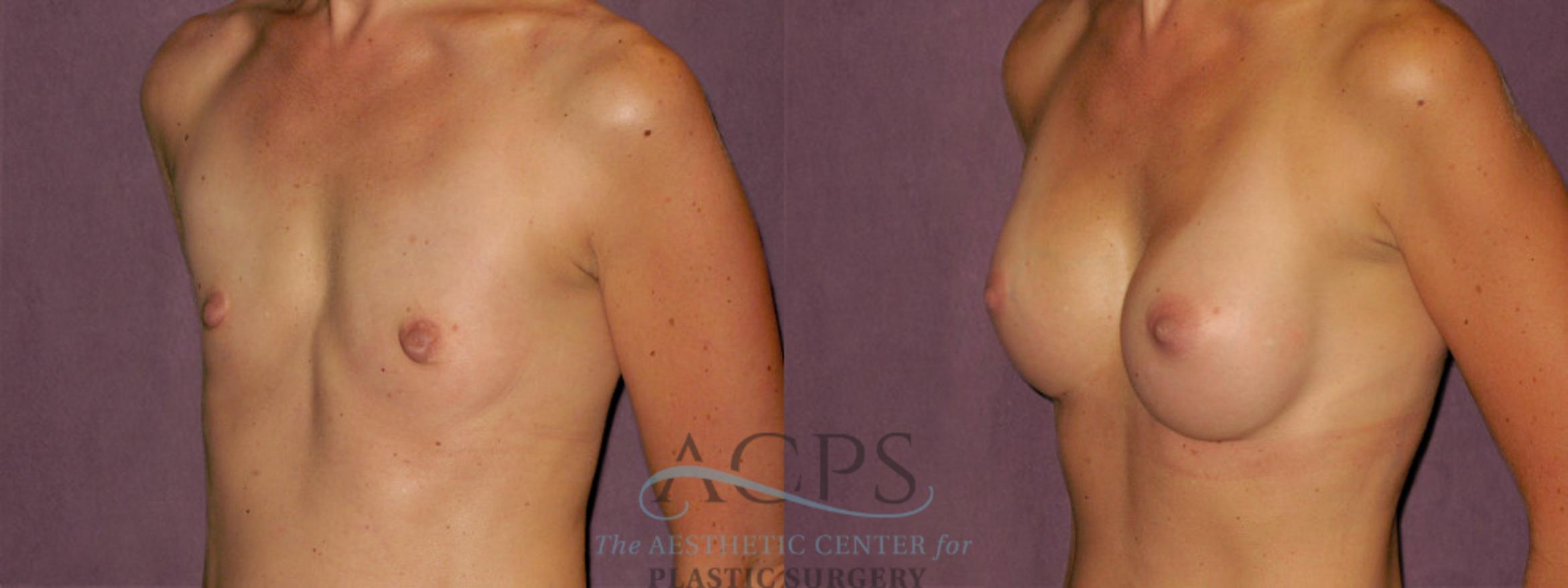 Before & After Breast Augmentation Case 955 Oblique Left View: View in Houston, TX