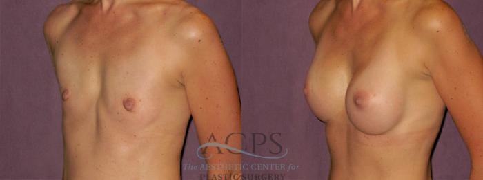 Before & After Breast Augmentation Case 955 Oblique Left View: View in Houston, TX