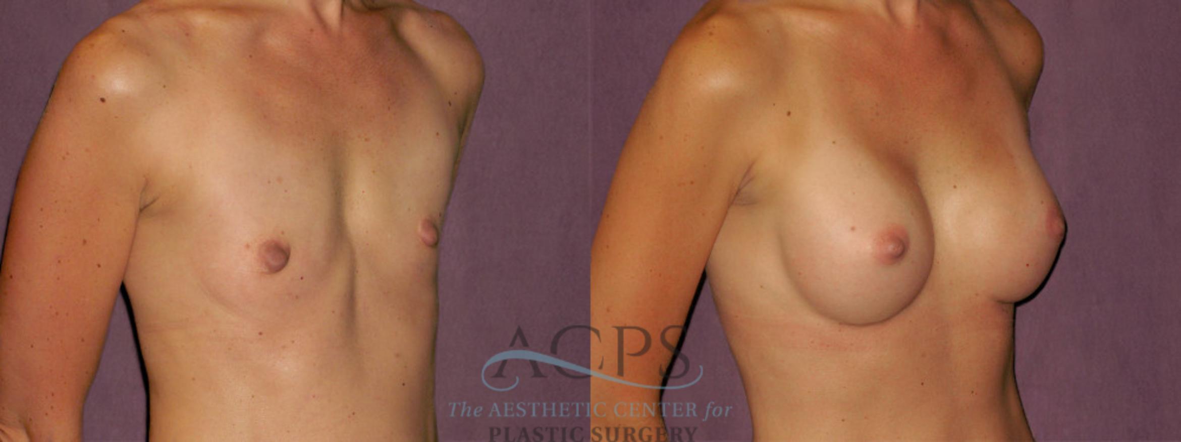Before & After Breast Augmentation Case 955 Oblique Right View: View in Houston, TX
