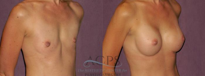 Before & After Breast Augmentation Case 955 Oblique Right View: View in Houston, TX