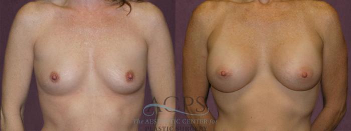 Before & After Breast Augmentation Case 956 Front View: View in Houston, TX