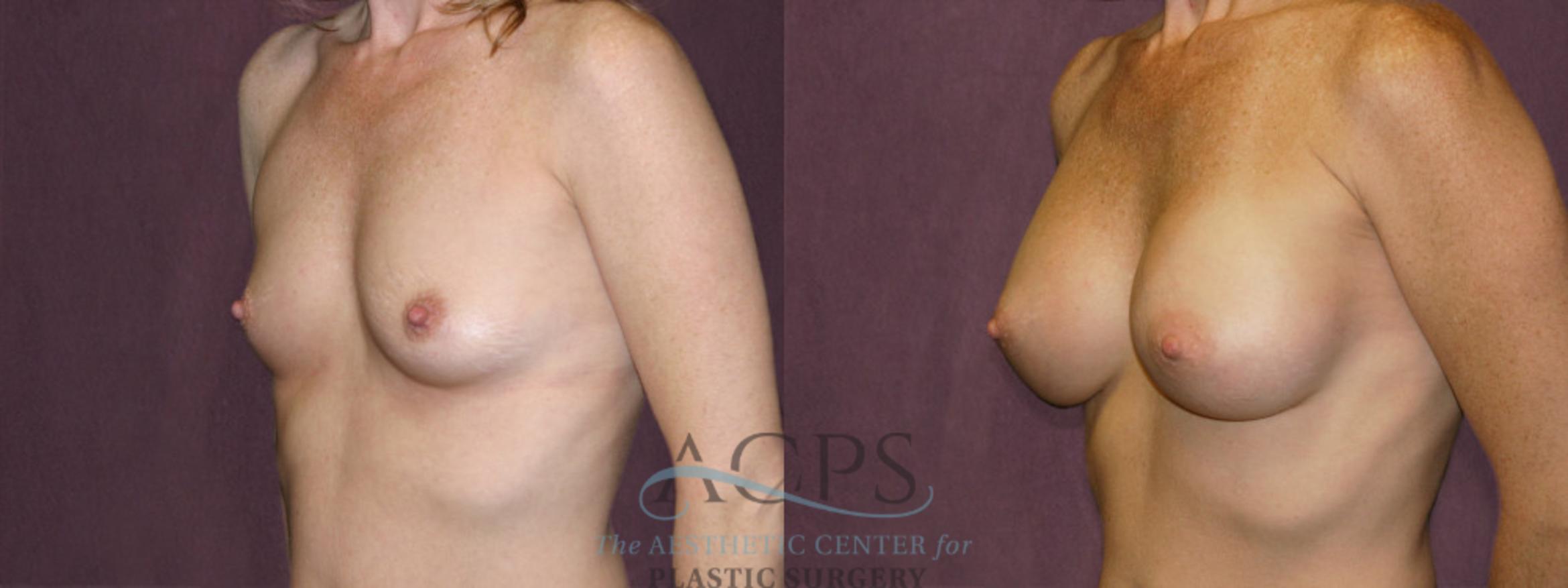 Before & After Breast Augmentation Case 956 Oblique Left View: View in Houston, TX