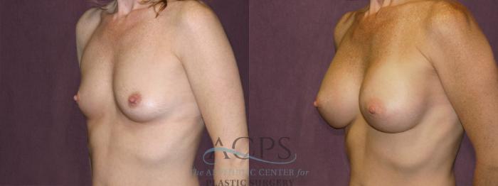 Before & After Breast Augmentation Case 956 Oblique Left View: View in Houston, TX