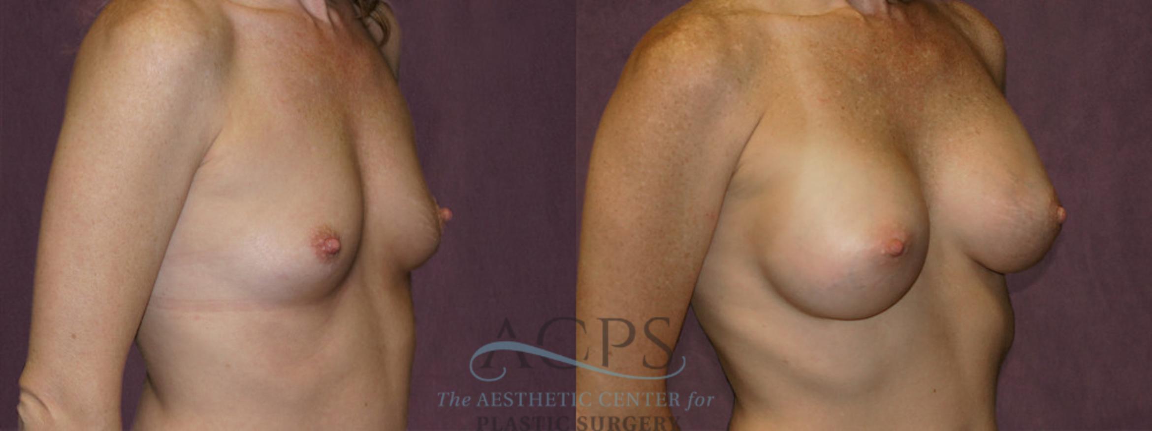 Before & After Breast Augmentation Case 956 Oblique Right View: View in Houston, TX