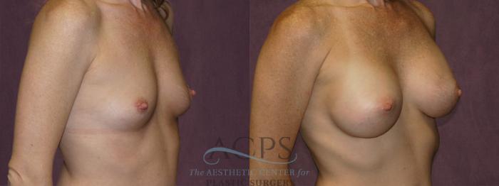 Before & After Breast Augmentation Case 956 Oblique Right View: View in Houston, TX