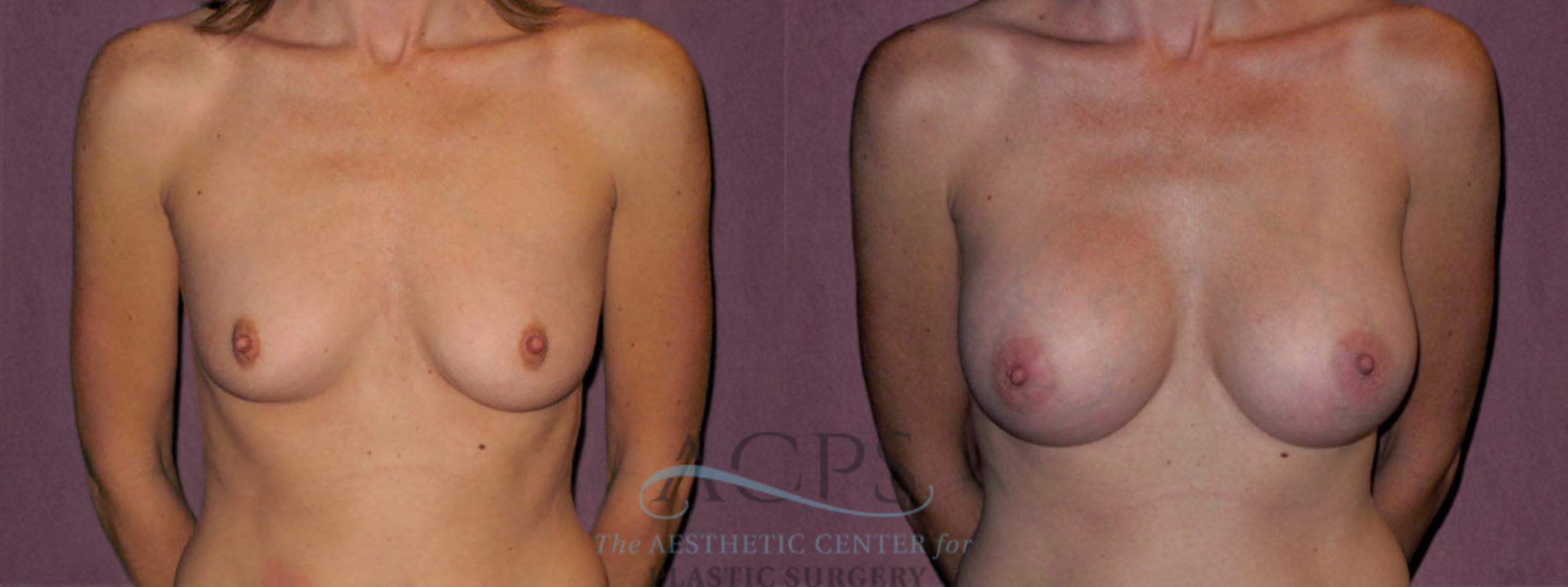 Before & After Breast Augmentation Case 957 Front View: View in Houston, TX