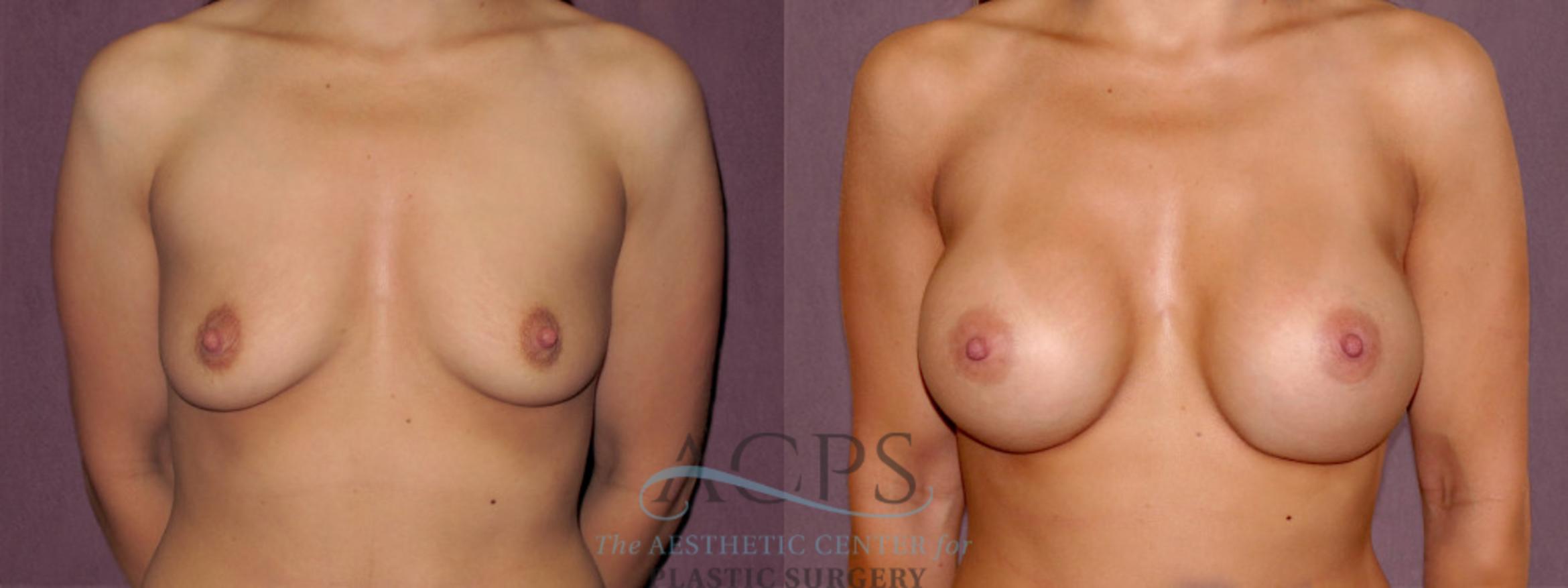 Before & After Breast Augmentation Case 958 Front View: View in Houston, TX