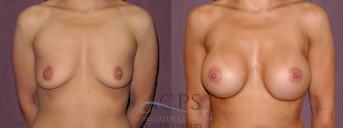 Before & After Breast Augmentation Case 958 Front View: View in Houston, TX