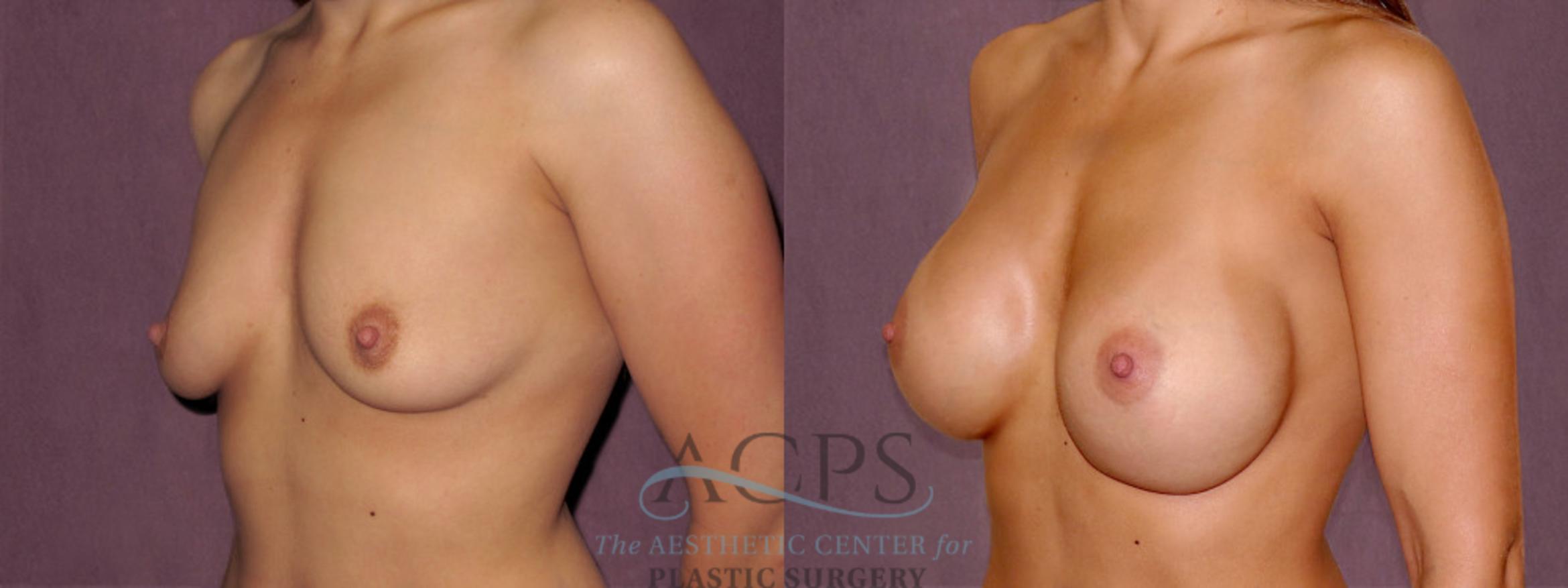 Before & After Breast Augmentation Case 958 Oblique Left View: View in Houston, TX