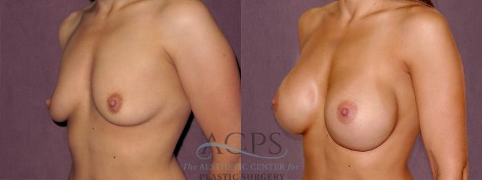 Before & After Breast Augmentation Case 958 Oblique Left View: View in Houston, TX