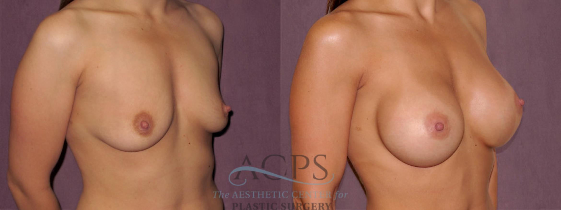 Before & After Breast Augmentation Case 958 Oblique Right View: View in Houston, TX