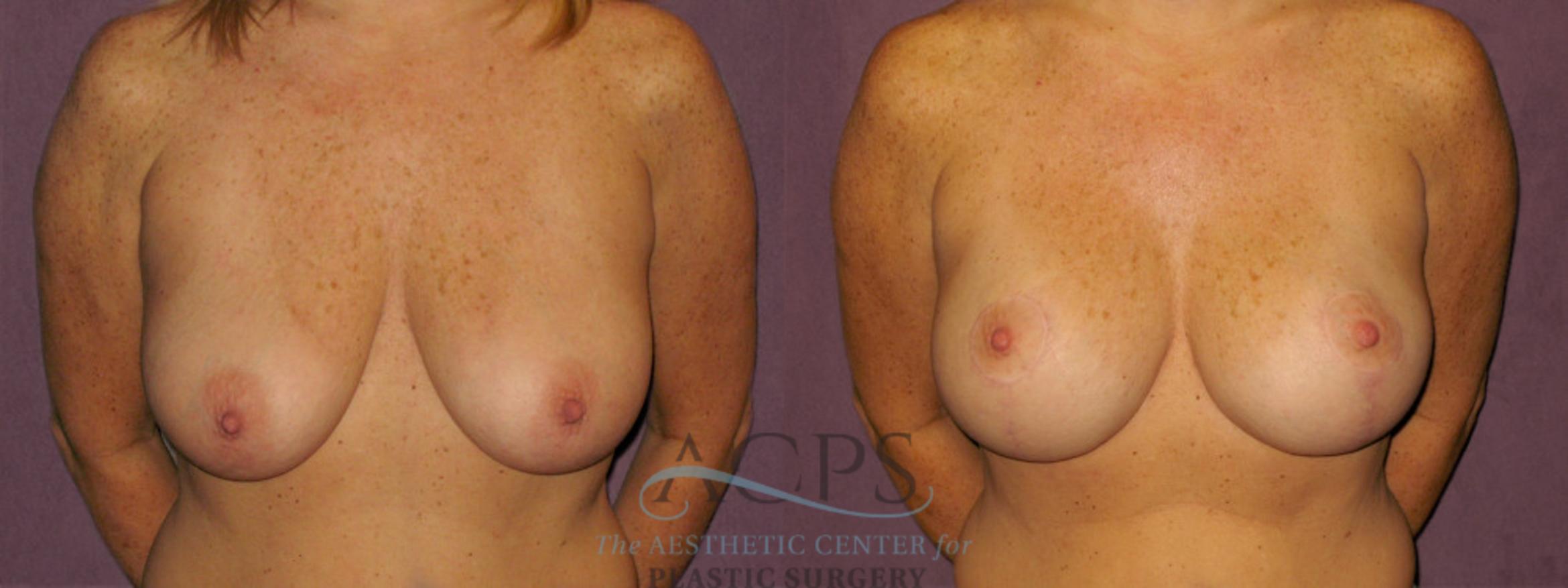 Before & After Breast Augmentation Case 959 Front View: View in Houston, TX