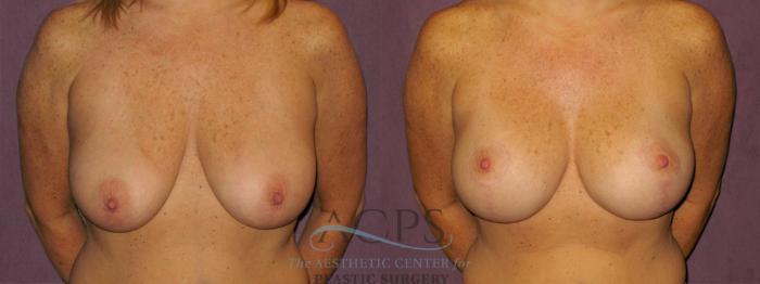 Before & After Breast Lift Case 959 Front View: View in Houston, TX