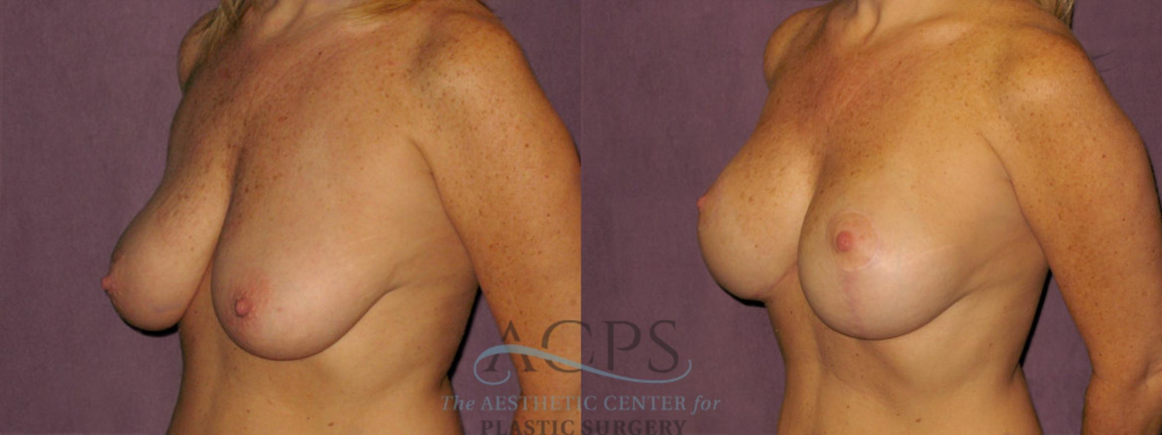 Before & After Breast Augmentation Case 959 Oblique Left View: View in Houston, TX