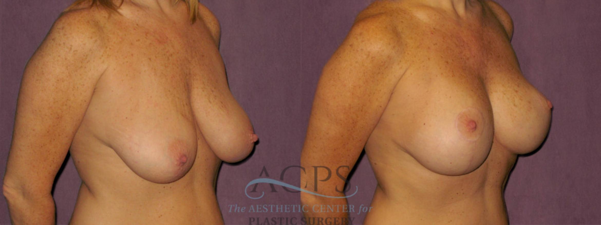 Before & After Breast Augmentation Case 959 Oblique Right View: View in Houston, TX
