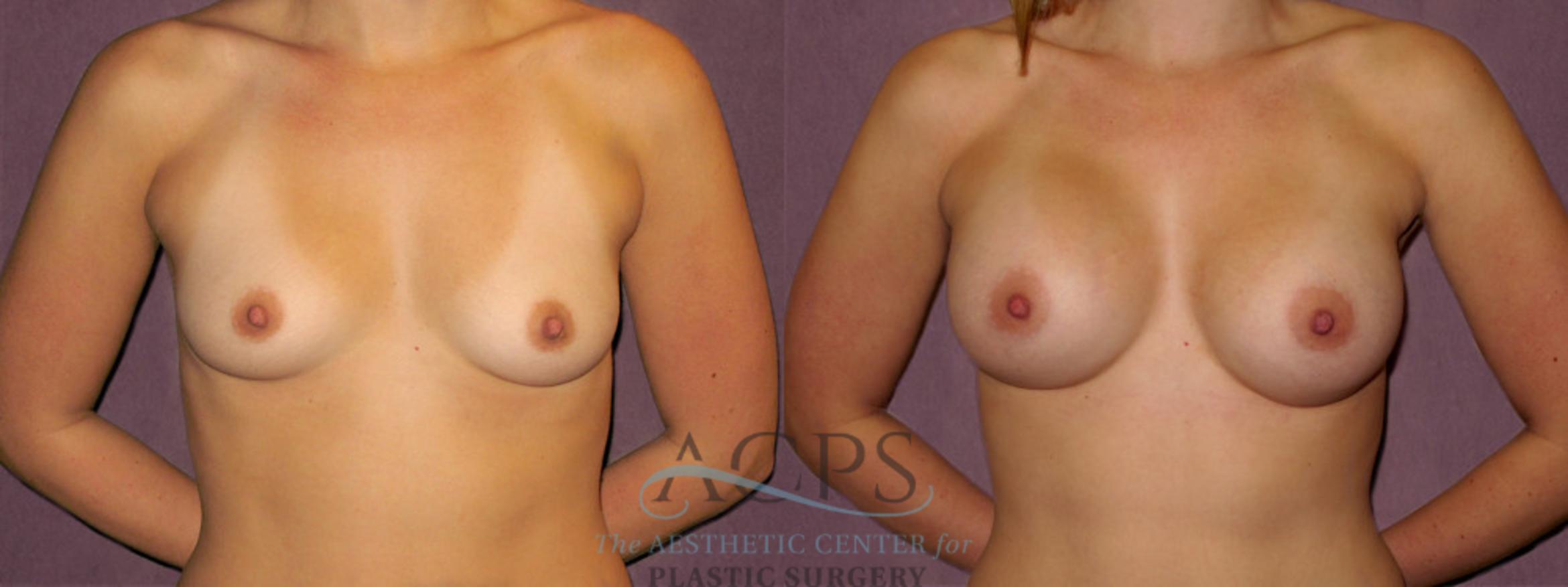 Before & After Breast Augmentation Case 960 Front View: View in Houston, TX
