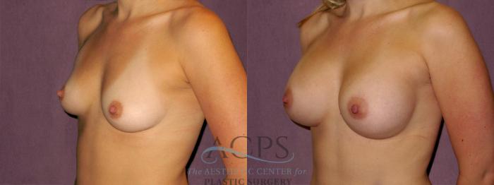 Before & After Breast Augmentation Case 960 Oblique Left View: View in Houston, TX